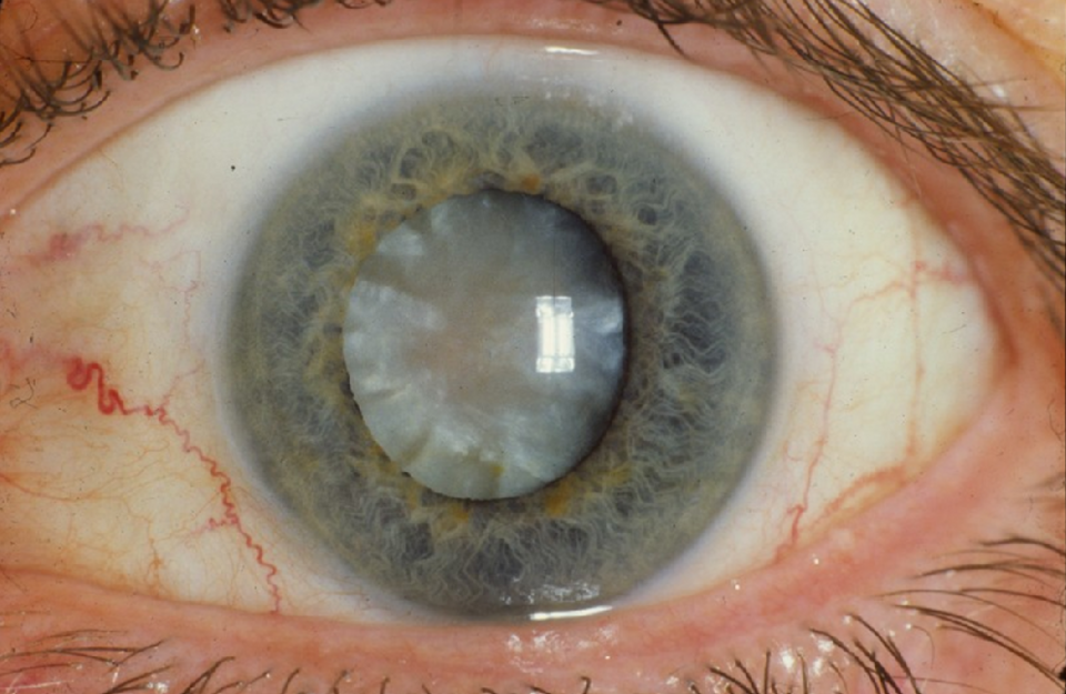 A hypermature age-related cortico-nuclear cataract with a brunescent (brown) nucleus. Credit: national Eye Institute, National Institutes of Health