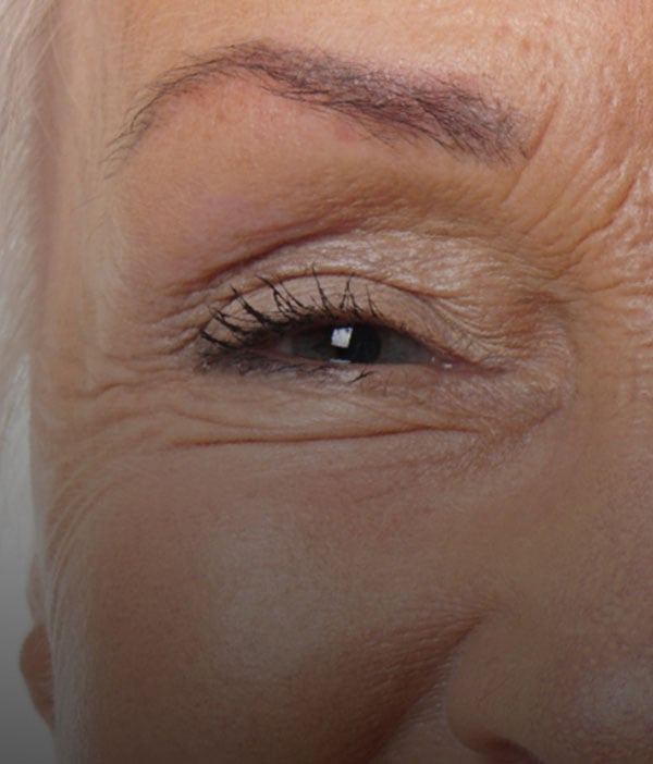 Ophthalmic Devices